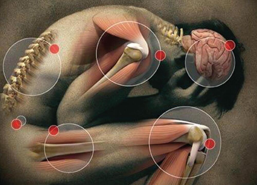 articulaciones del cuerpo afectadas por artrosis