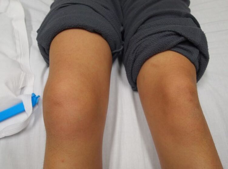 deformidad de la articulación de la rodilla con artrosis