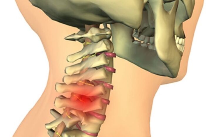 dolor de cuello por artrosis