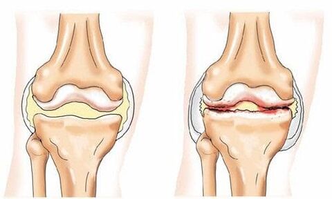 articulación de la rodilla sana y artrósica
