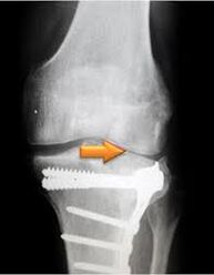 Artrosis de la articulación de la rodilla